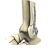 Ankle Fracture Fixation