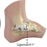 Ankle Ligament Repair