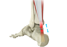 Achilles Tendon Injury