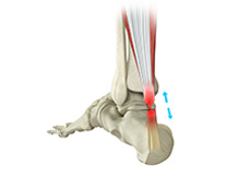 Achilles Tendon Repair