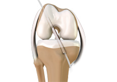 ACL Reconstruction