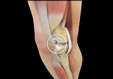 ACL Tears