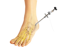Ankle Arthroscopy