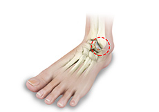 Ankle Cartilage Injury