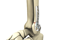 Ankle Fracture Fixation