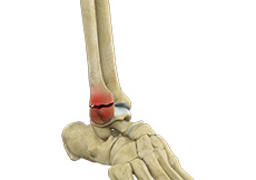 Ankle Fracture/Broken Bone