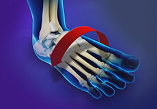 Ankle Instability