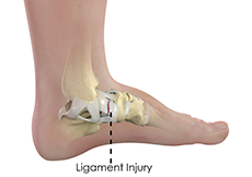 Ankle Ligament Repair