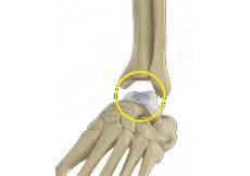 Ankle OCD