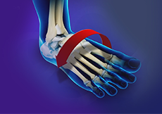 Ankle Stabilization