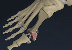 Bunion Correction