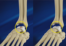 Cartilage Procedures of the Ankle