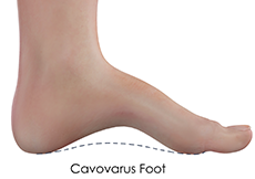 Cavus Foot Reconstruction