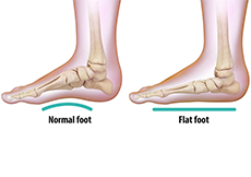 Flatfoot Reconstruction