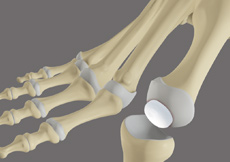 Foot Arthritis/Cartiva