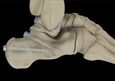 Foot Fracture Fixation