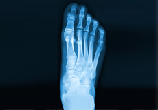 Foot Fracture/Broken Bone