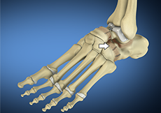 Foot Fusion Procedure