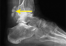 Loose Body in the Ankle