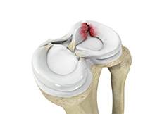 Meniscal Repair