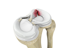 Meniscus Tear