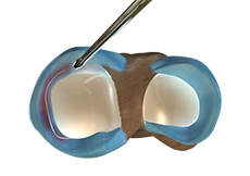 Partial Menisectomy