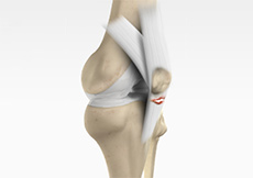 Patella Tendon Tear