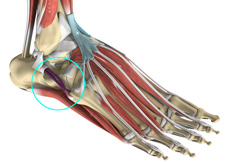 Peroneal Tendon Injury