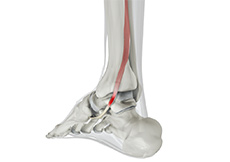 Posterior Tibial Tendon Injury