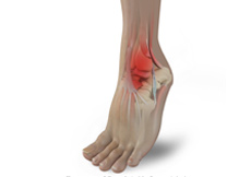 Sports Foot and Ankle Injuries