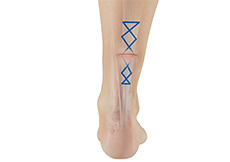 Tendon Repair
