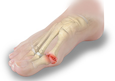 Toe Arthritis