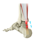 Achilles Tendon Injury