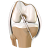 ACL Reconstruction