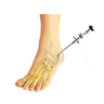 Ankle Arthroscopy