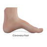 Cavus Foot Reconstruction