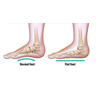 Flatfoot Reconstruction