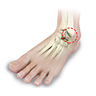 Foot Arthritis