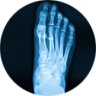 Foot Fracture/Broken Bone