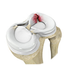 Meniscal Repair