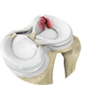 Meniscus Tear